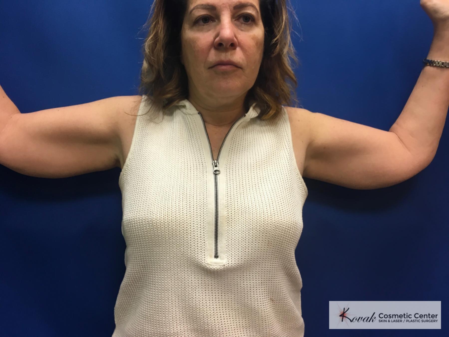 Laser Liposuction: Patient 6 - Before 
