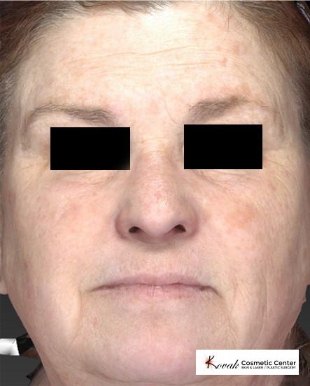 Halo™: Patient 1 - Before 