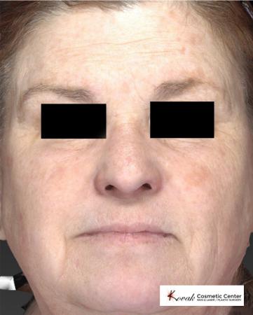 Halo™: Patient 1 - Before 1