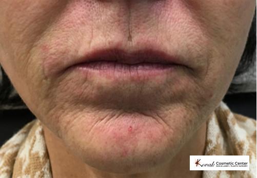 Restylane® Silk: Patient 4 - Before 