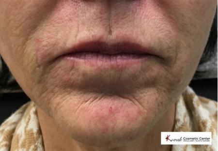 Restylane® Silk: Patient 4 - Before Image 1