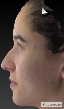 Venus Viva: Patient 3 - After Image 2