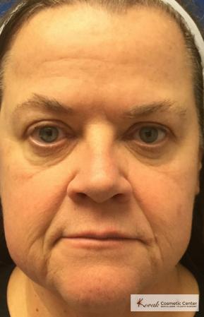 Restylane® Silk: Patient 13 - After 1