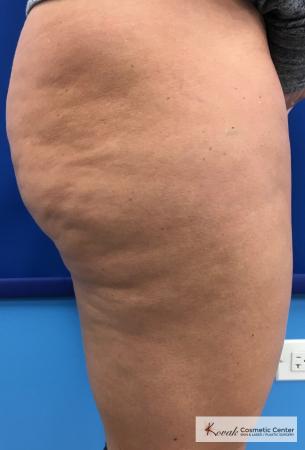 Cellulite Reduction: Patient 4 - Before and After 3