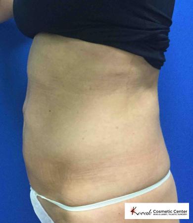 EMSCULPT®: Patient 2 - Before 2