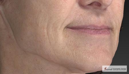 Injectables - Mouth: Patient 8 - After Image 5