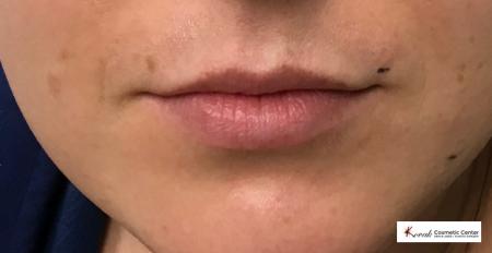 Juvéderm® XC: Patient 4 - Before Image 1
