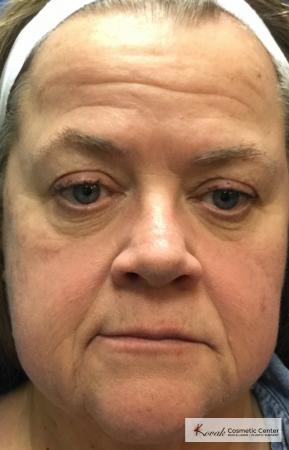 Restylane® Silk: Patient 13 - Before 1