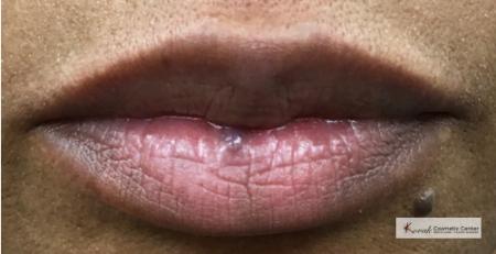 Lumps & Bumps: Patient 2 - Before Image 1
