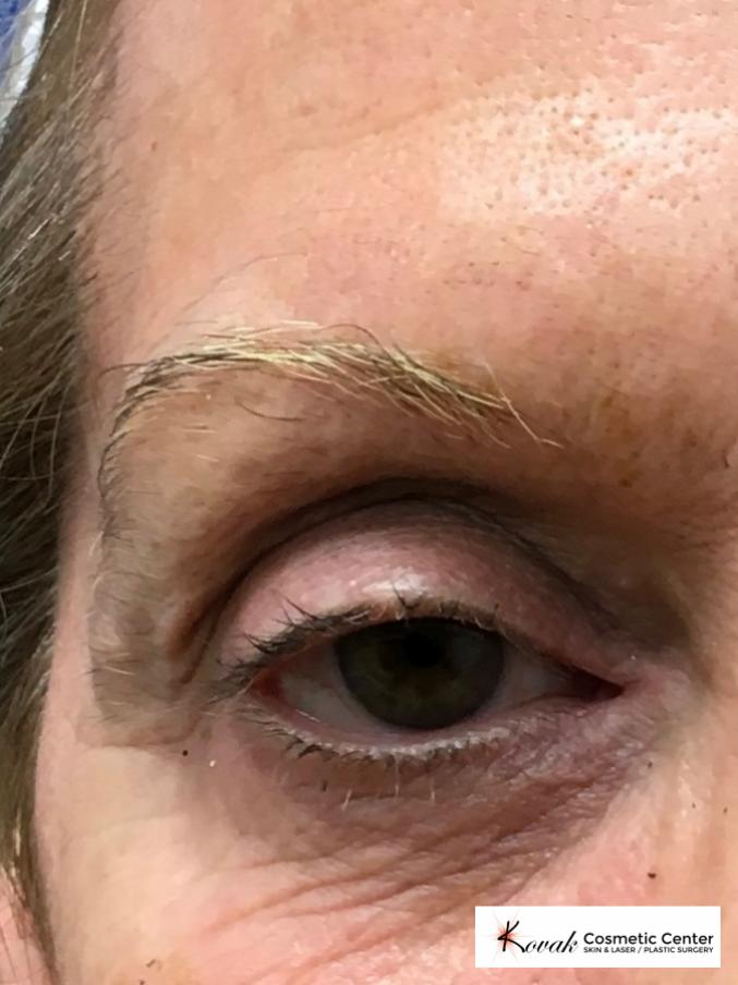 Modified Botox Brow Raise on a 64 year old Woman - After  