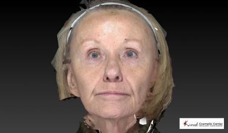 Halo™: Patient 2 - Before 2