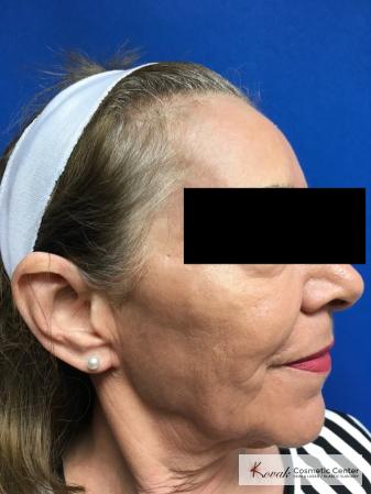 Full Face Laser Skin Resurfacing on a 70 year old woman - After Image 3