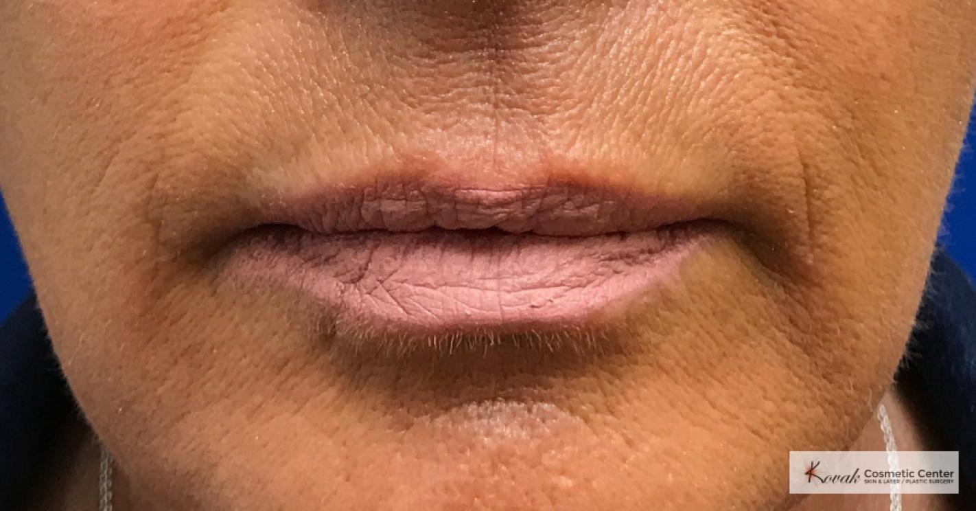 Lip Augmentation: Patient 4 - Before 
