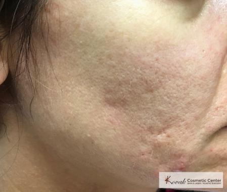 Acne Scars treated with Venus Viva on 35 year old woman - Before and After Image 2