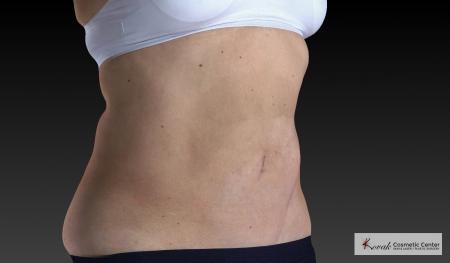 CoolSculpting®: Patient 18 - After 2