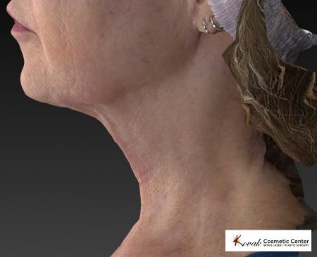 Kybella: Patient 2 - After Image 4