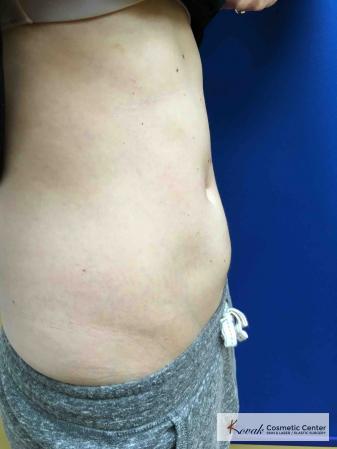 Laser Liposuction of the abdomen on a 28 year old female - After 2