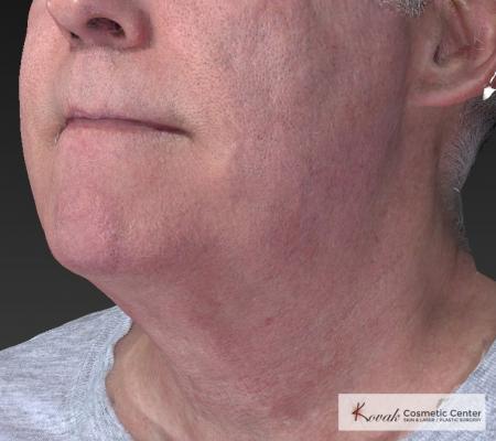 Kybella: Patient 4 - After Image 3
