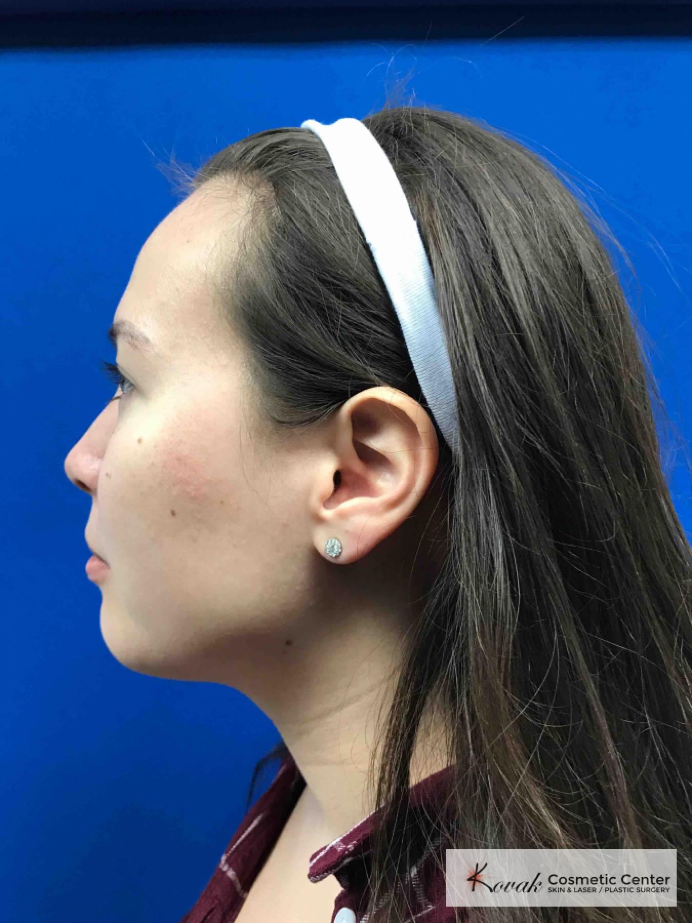 Restylane® Lyft: Patient 2 - After  