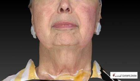 Kybella: Patient 3 - Before Image 3