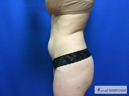 CoolSculpting®: Patient 17 - Before 2