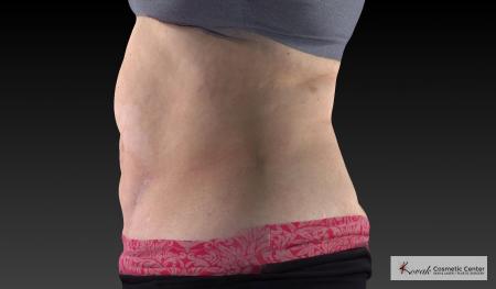 CoolSculpting®: Patient 18 - After 5