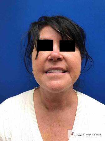 Neck Lift: Patient 2 - After 1