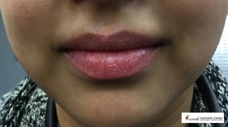 Juvéderm® XC: Patient 3 - Before Image 1