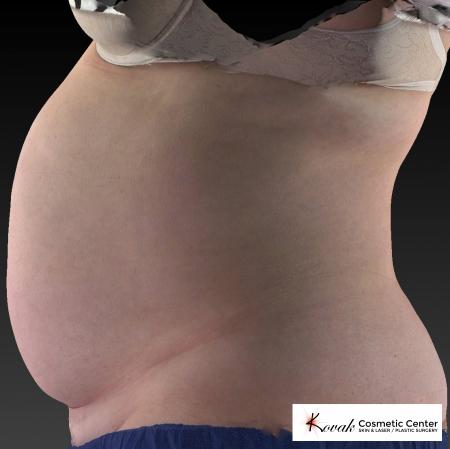 CoolSculpting®: Patient 11 - Before 3