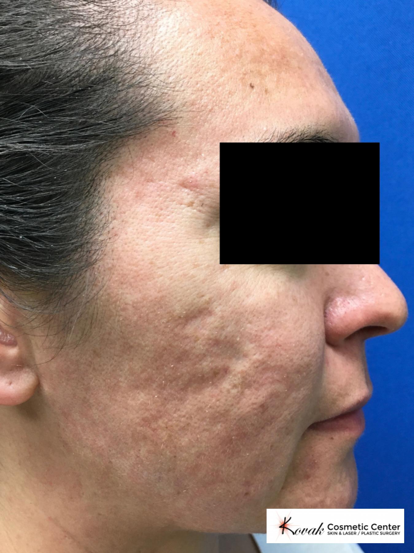 Filler for Acne Scars using Juvederm on a 32 year old female - Before 