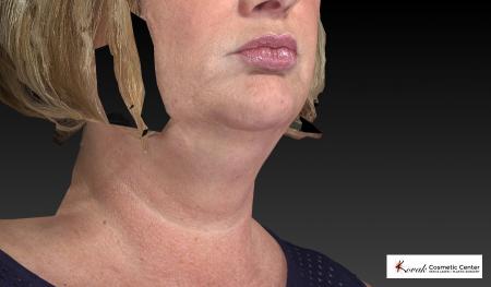 Kybella: Patient 1 - Before Image 2