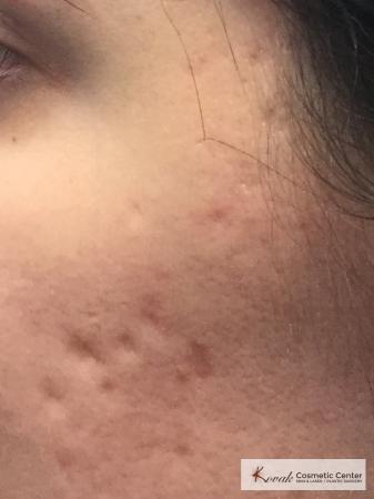 Acne Scars treated with Venus Viva on 28 year old woman - Before and After Image 2