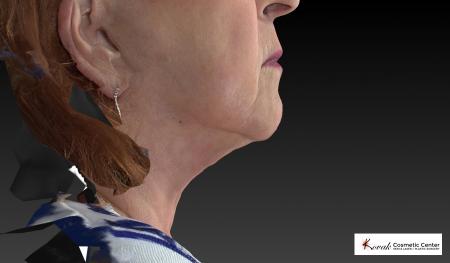 CoolSculpting®: Patient 5 - After 2
