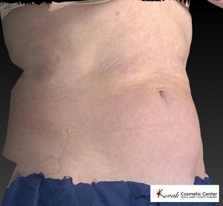 CoolSculpting®: Patient 13 - Before 3
