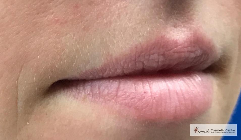 Restylane®: Patient 2 - Before 2
