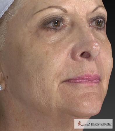 Injectables - Face: Patient 1 - After 3
