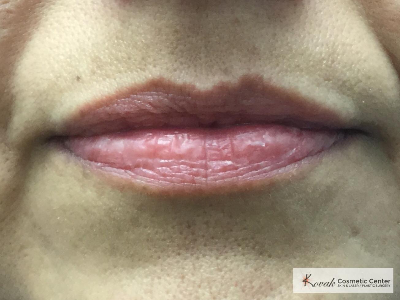 Juvederm treatment to fill the lips on 37 year old female - Before 