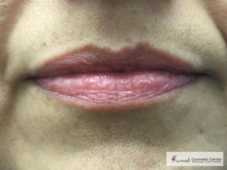 Juvederm treatment to fill the lips on 37 year old female - Before 1