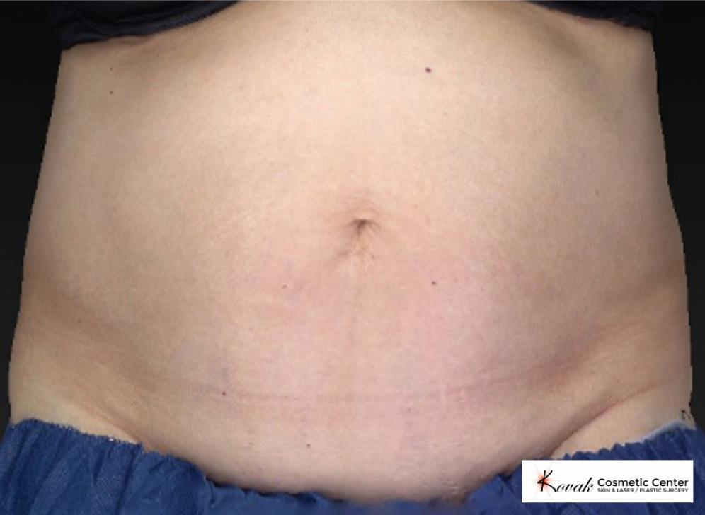 CoolSculpting®: Patient 8 - Before 