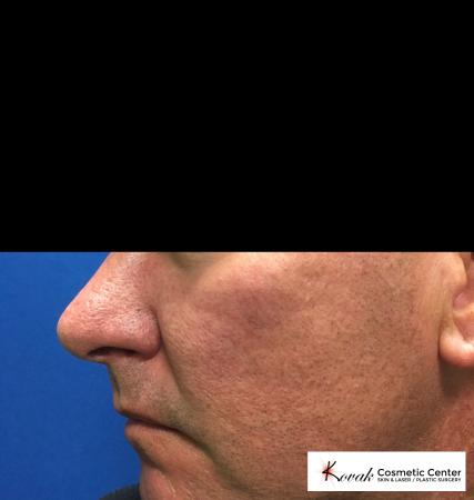 Juvéderm® XC: Patient 1 - After 4
