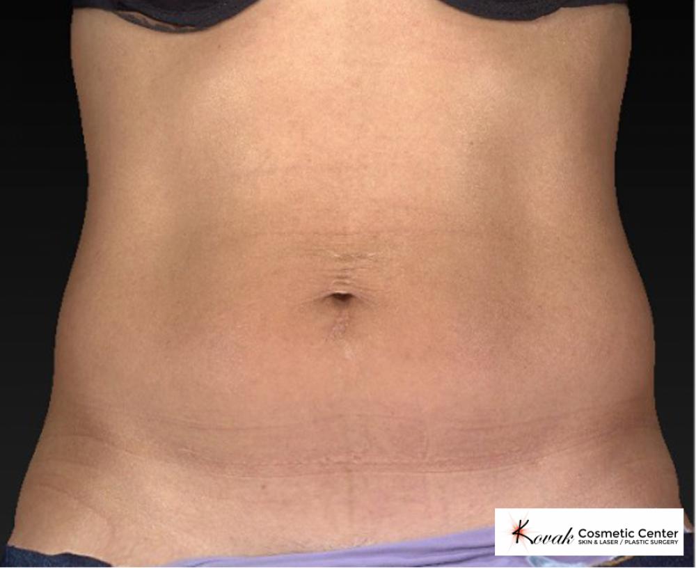 CoolSculpting®: Patient 9 - After  