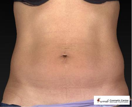 CoolSculpting®: Patient 9 - After 1