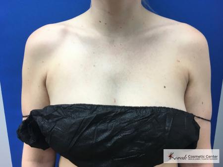 Laser Liposuction: Patient 4 - After 3