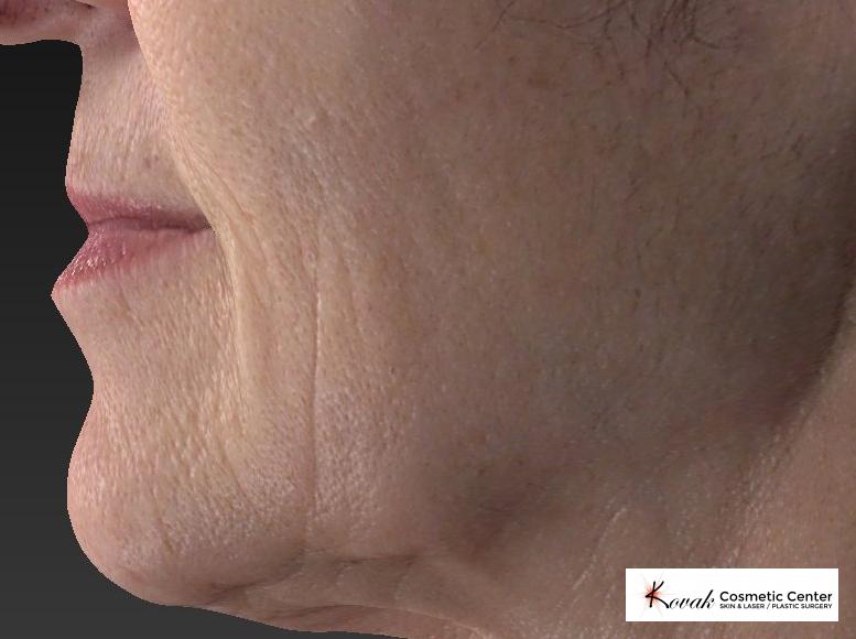 Restylane® Silk: Patient 2 - Before 3