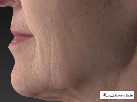 Restylane® Silk: Patient 2 - Before Image 3