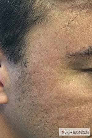 Acne Scars treated with Juvederm on 47 year old male - After Image 2
