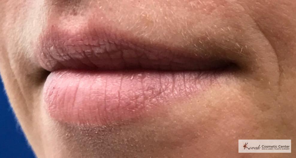 Restylane®: Patient 2 - Before 