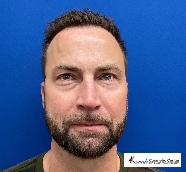 Fillers: Patient 3 - Before 1