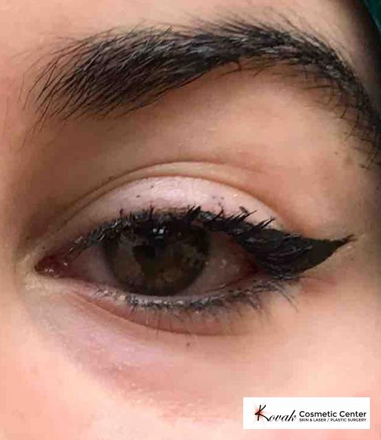 Eye Treatments: Patient 1 - Before and After 2