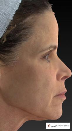 Silhouette Lift™: Patient 1 - After Image 1